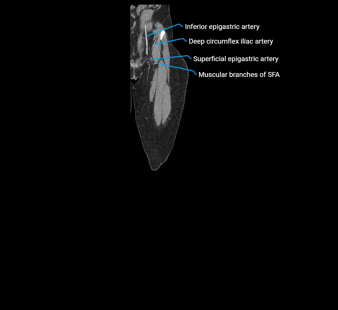 CTA lower limb coronal cross sectional anatomy labelled image _10 (1).webp